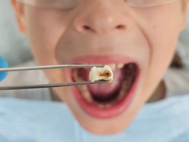 Best Teeth Whitening  in Livingston, AL